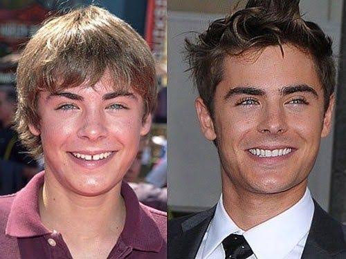 10 Celebrities Who Thank Braces for Their Perfect Smiles - Thurman