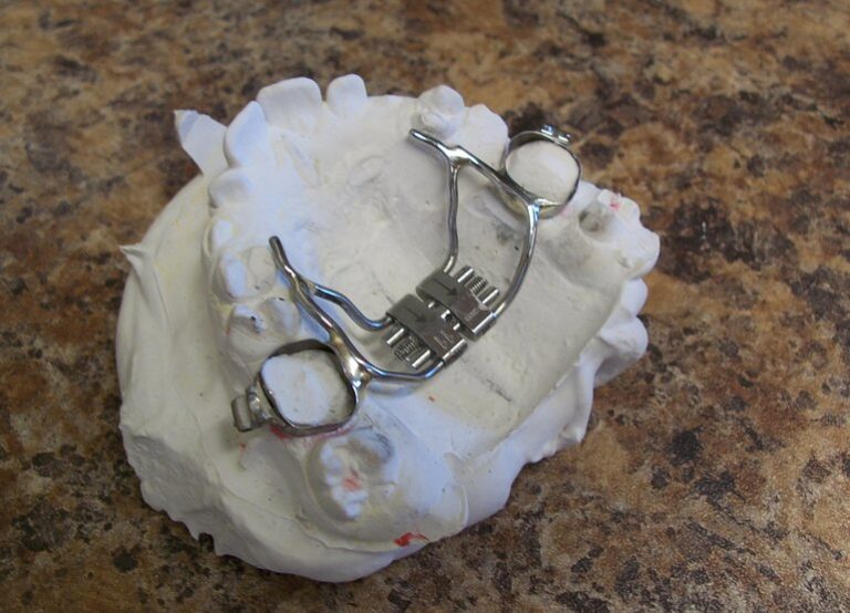 Palate Expander for Kids | Thurman Orthodontics