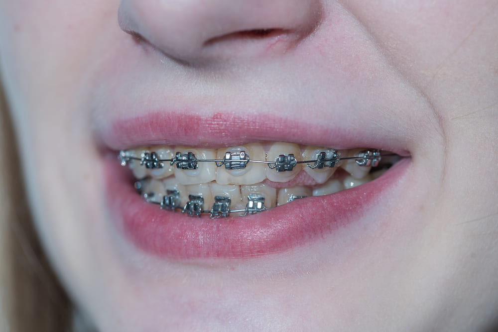 How to Fix an Underbite? Causes & Treatments - Thurman Orthodontics