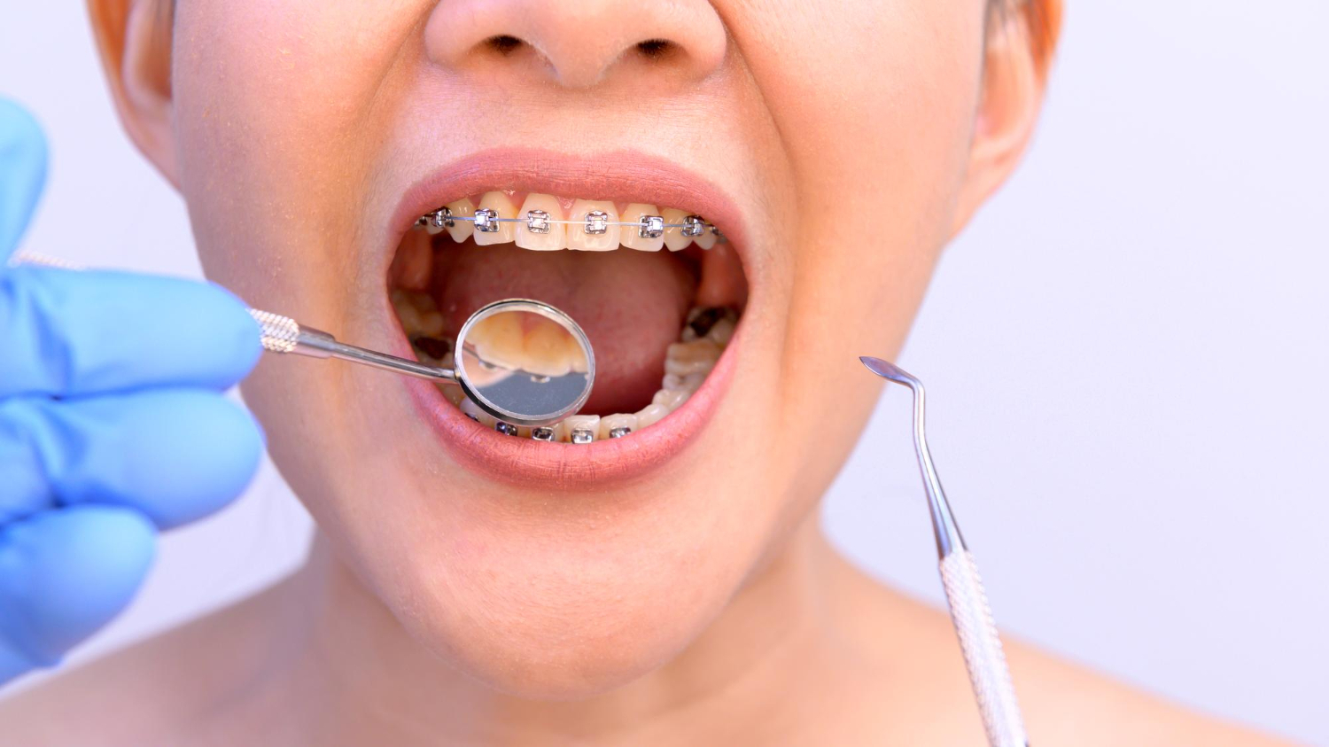 braces with cavities